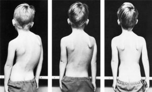 Scoliosis-pilates-barcelona