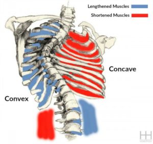 Scoliosis-pilates-barcelona 4